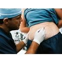 Liposuction UK : Liposuction UK