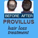 Provillus Hair Loss Treatment and Prevention : say goodbye to hair loss
