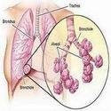 Asbestosis Mesothelioma Information : Asbestosis Mesothelioma