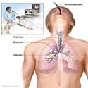 MESOTHELIOMA VICTIMS : 